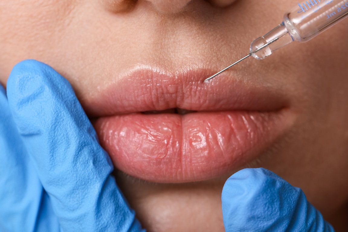 Bioplastía con Ácido Hialurónico en Cosmeclinic Las Condes