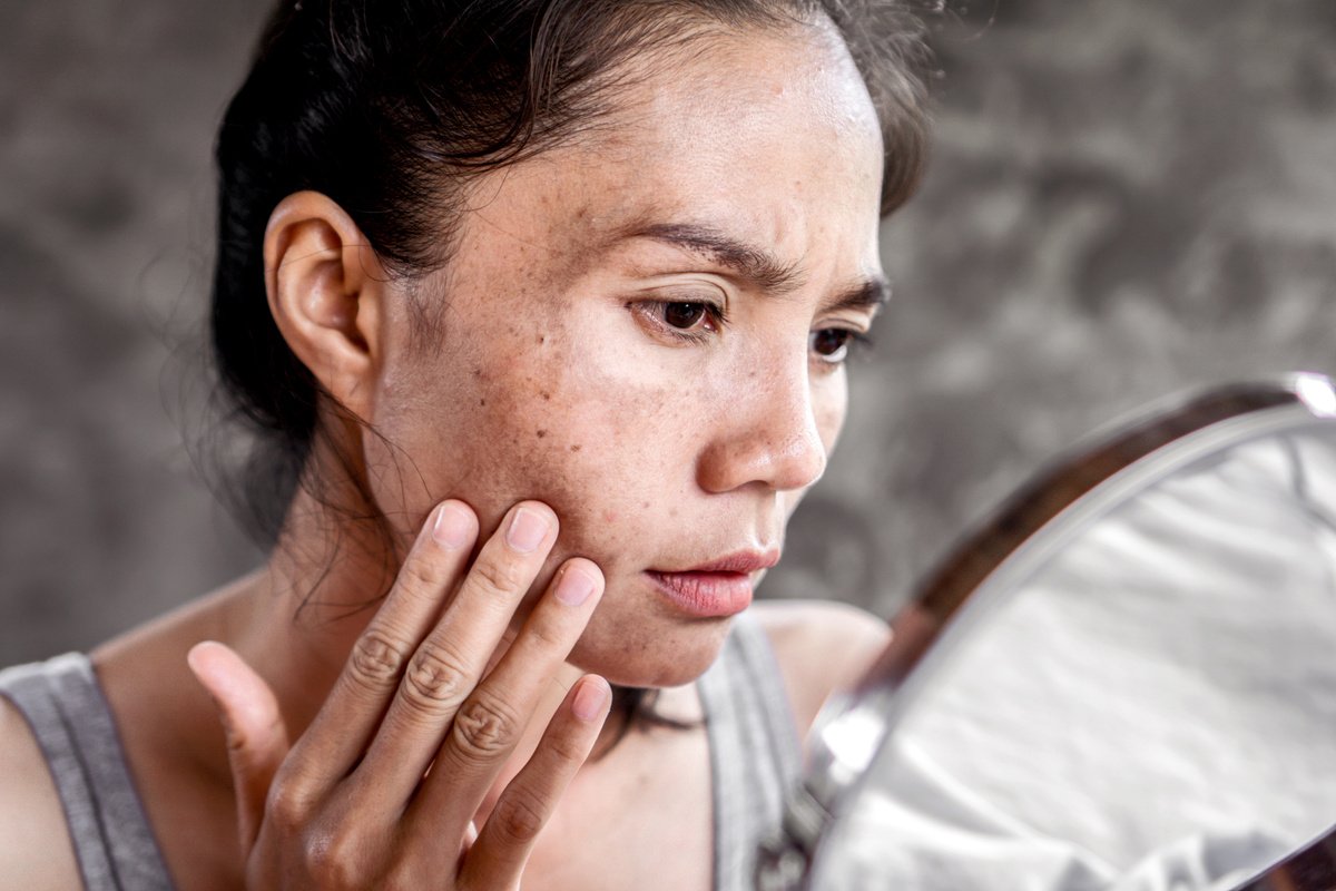 Piel con manchas antes del plan Skin Tone Balance