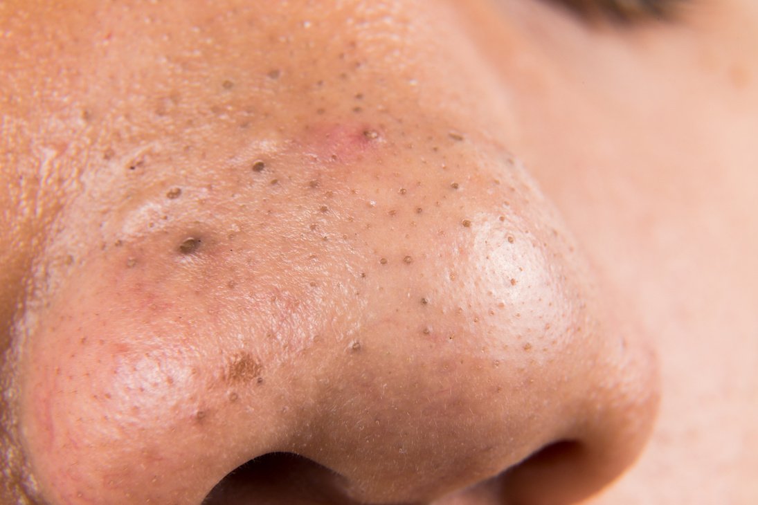 Facial Acné
