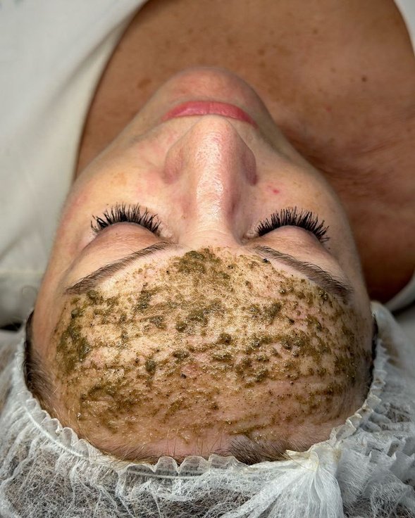 Peeling de Algas (Bio-Needling) en Cosmeclinic Las Condes