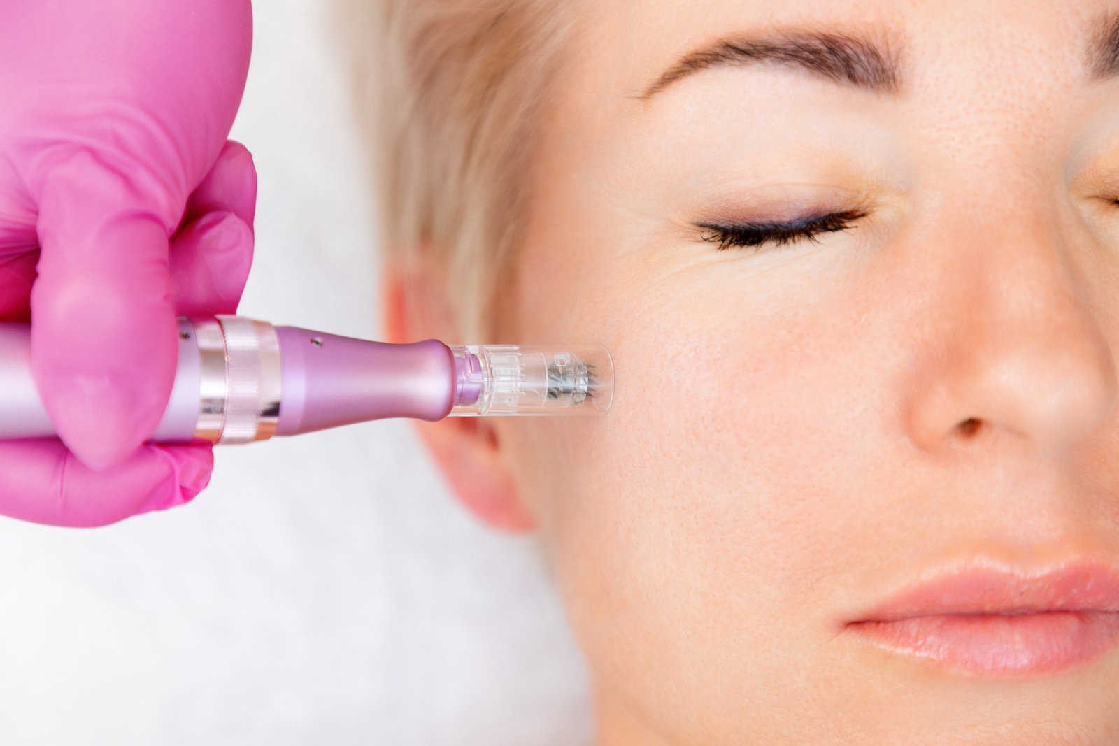 Radiofrecuencia Fraccionada en Cosmeclinic Las Condes