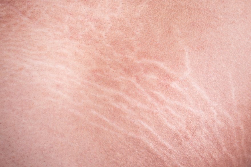 Tratamiento de Estrías en Cosmeclinic Las Condes